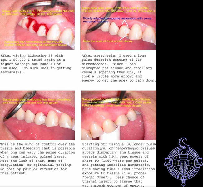 EBHemostasis.jpg