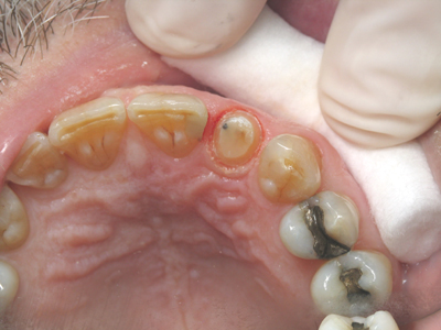 incisalprep400.jpg